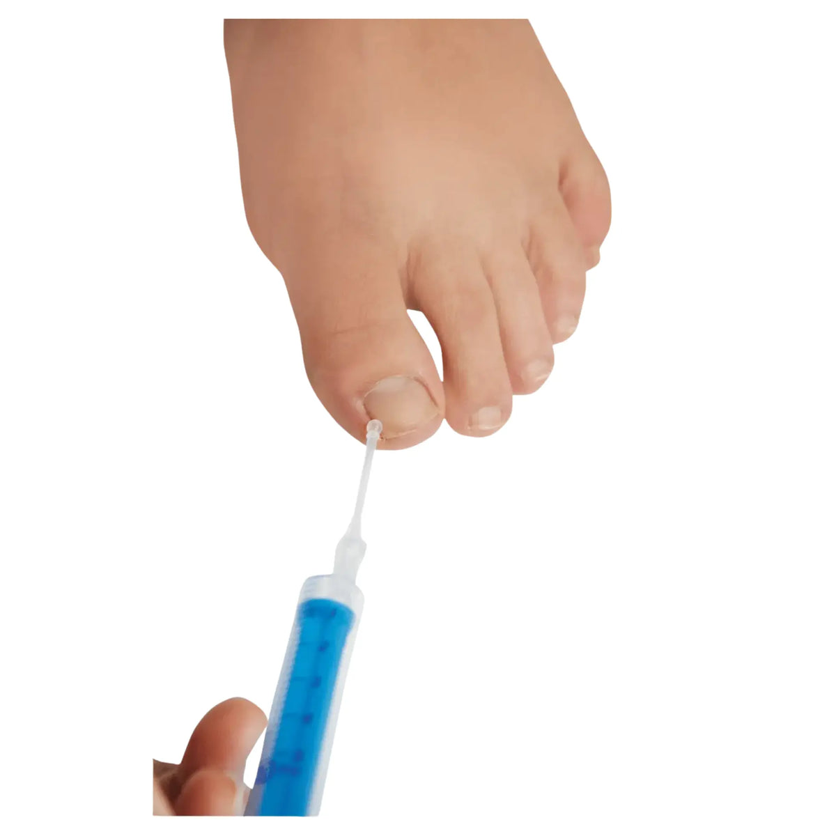 Sterile disposable button cannula - Ruck Ruck 