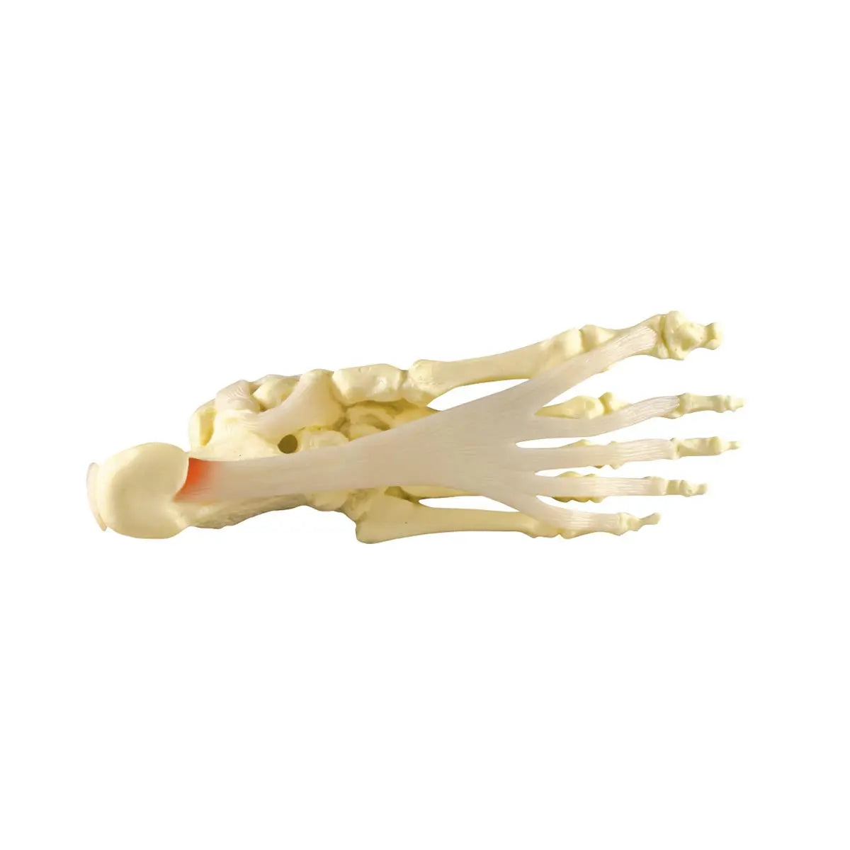 Plantar fasciitis model – Foot/Ankle - My Podiatry