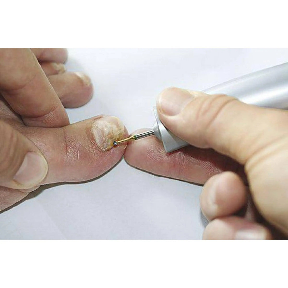 1SXM Tungsten carbide bur - Enucleation of corns - 1.6 mm - My Podology