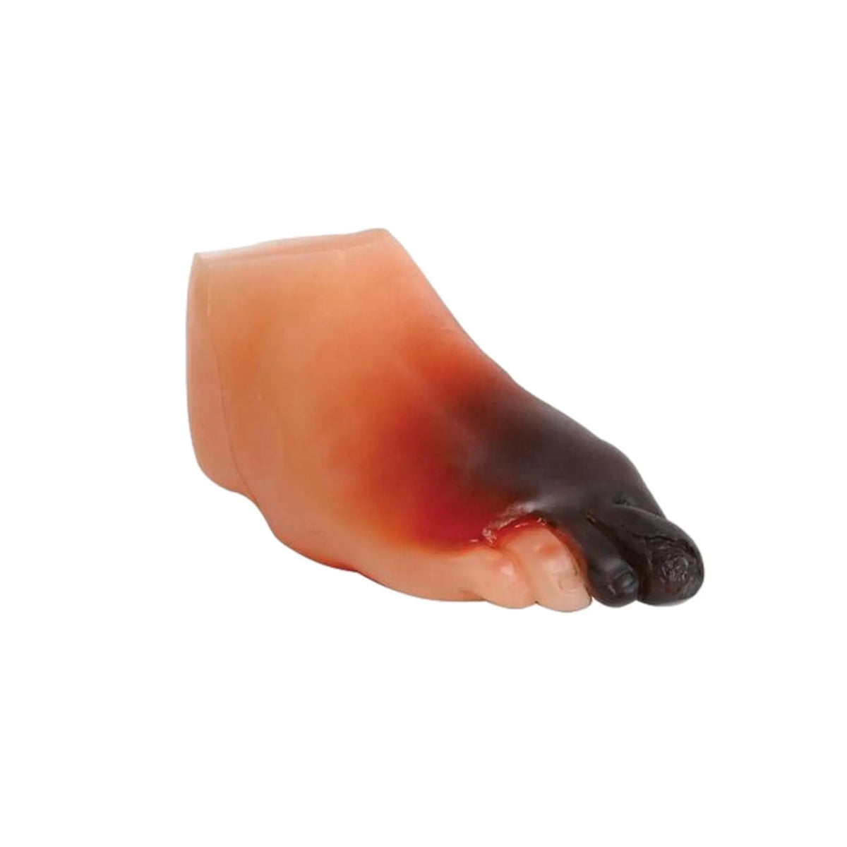 Severe diabetic foot model - Anatomy and pathology - My Podiatry