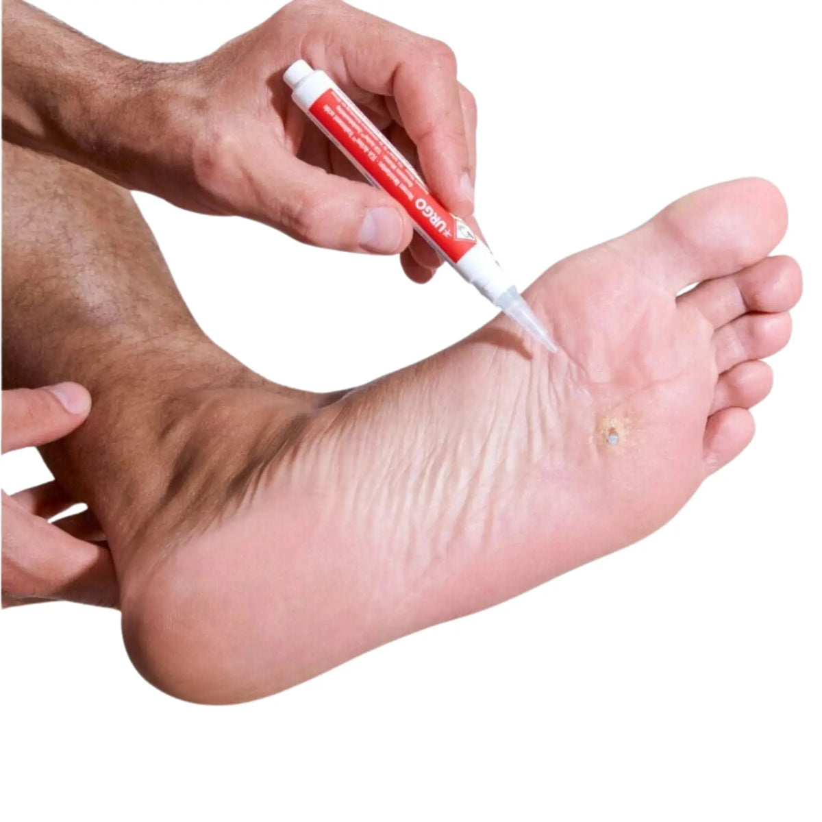 Pen for treatment of resistant warts - 2 ml - Urgo Urgo 