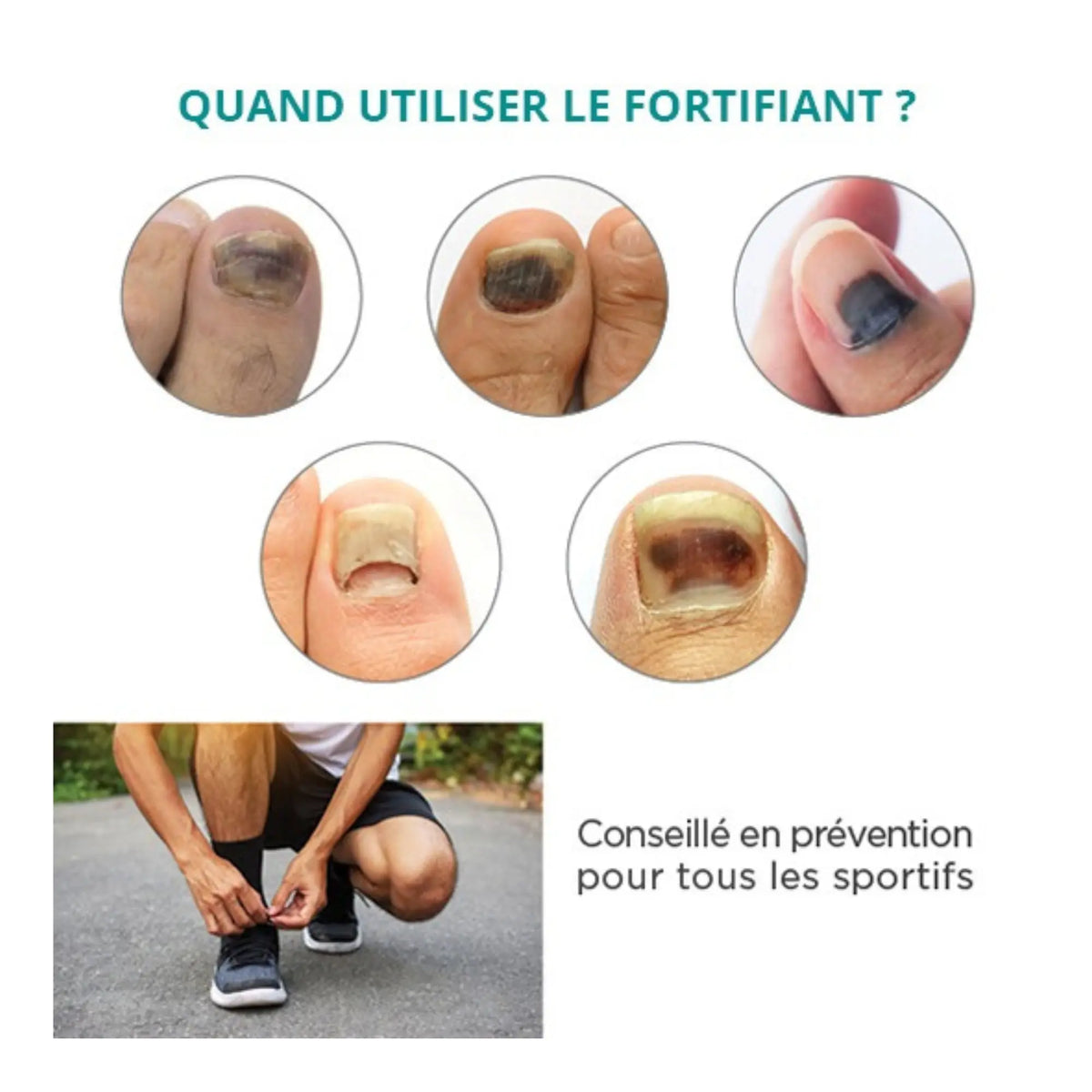 Treatment Black, traumatized nails - 30ml - Strengthening - Application with pipette - Poderm Professional - My Podologie