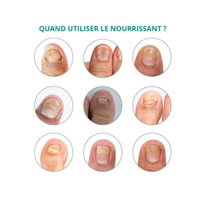 Treatment for Striated, dry, brittle nails - 30ml - Nourishing - Application with pipette - Poderm Professional - My Podologie