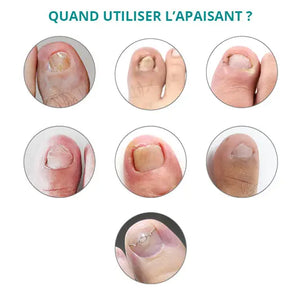 Tratamiento sérum para uñas encarnadas e incrustadas - 8 ml - Calmante - Poderm Professional - My Podologie